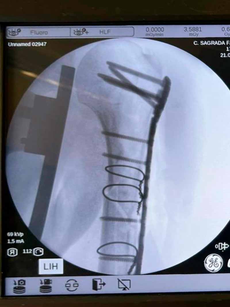 fractura-de-humero-lesiones-hombro-2 fractura-de-humero-lesiones-hombro-2