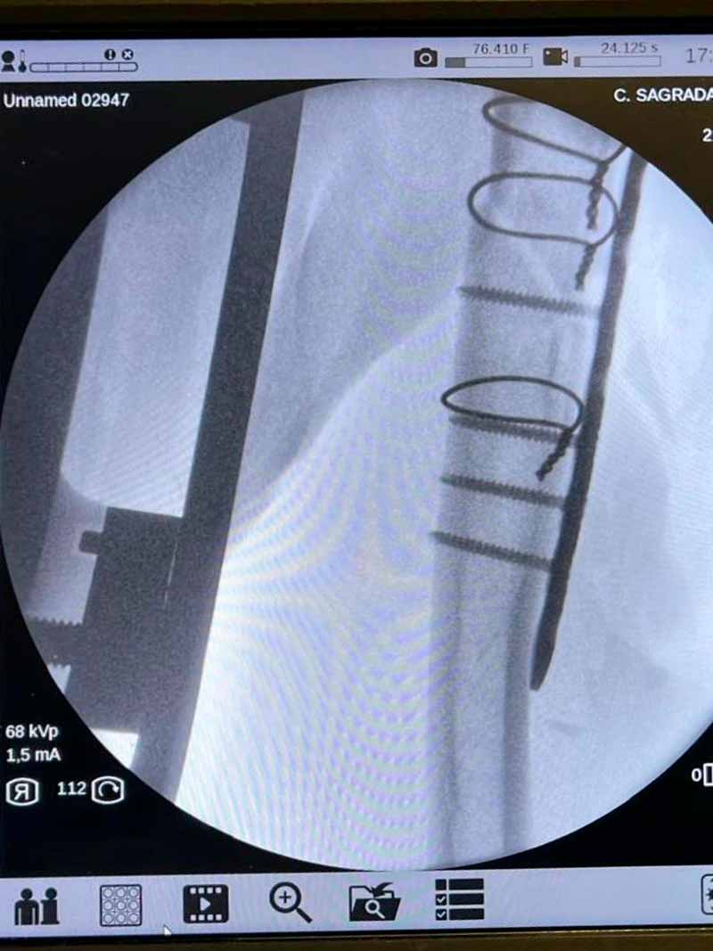 fractura-de-humero-lesiones-hombro-3 fractura-de-humero-lesiones-hombro-3