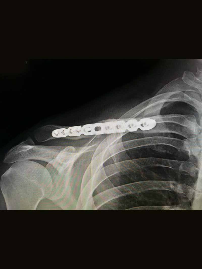lesiones-fractura-de-clavicula-hombro lesiones-fractura-de-clavicula-hombro