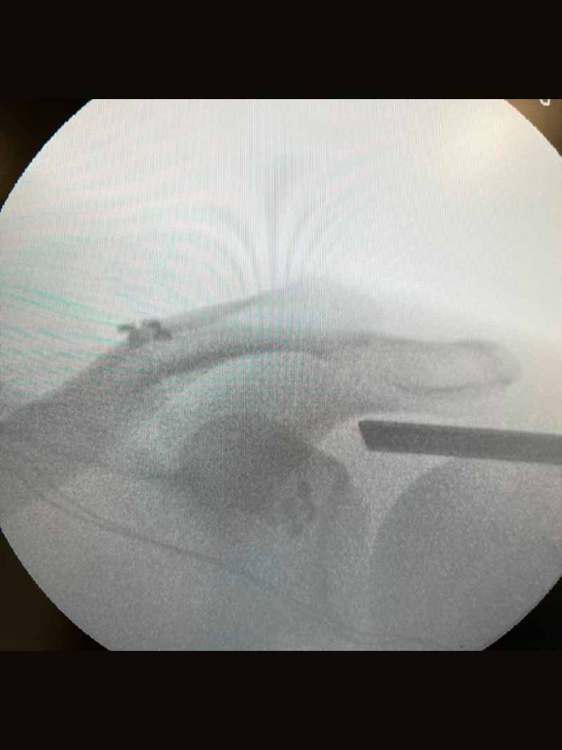 lesiones-hombro-luxaciones-acromioclaviculares-3 lesiones-hombro-luxaciones-acromioclaviculares-3