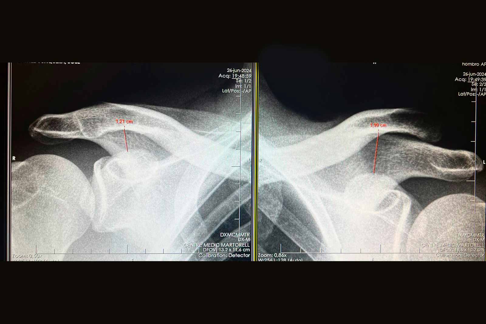 lesiones-hombro-luxaciones-acromioclaviculares lesiones-hombro-luxaciones-acromioclaviculares