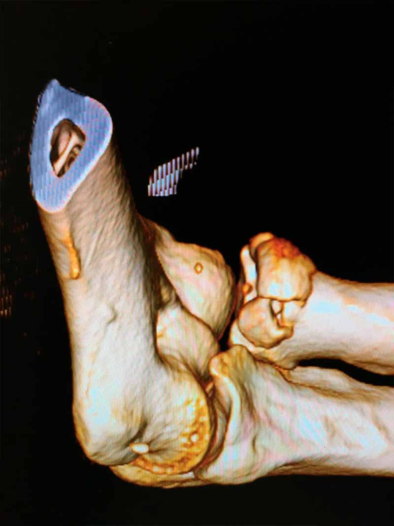 ruptura-y-tendinitis-del-biceps-distal-1 ruptura-y-tendinitis-del-biceps-distal-1