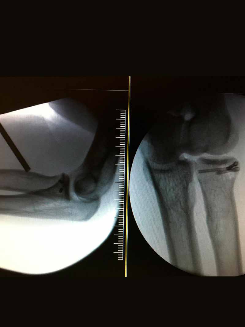 ruptura-y-tendinitis-del-biceps-distal-2 ruptura-y-tendinitis-del-biceps-distal-2