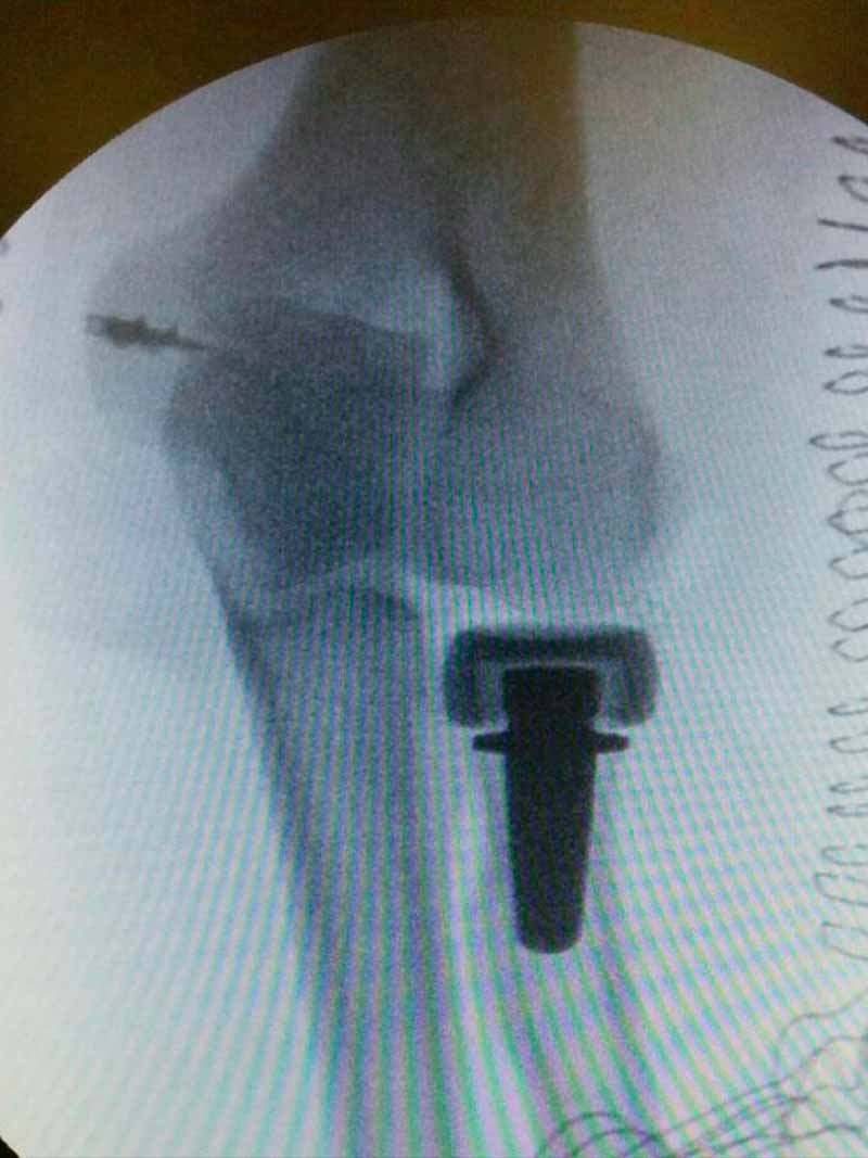 ruptura-y-tendinitis-del-biceps-distal-3 ruptura-y-tendinitis-del-biceps-distal-3
