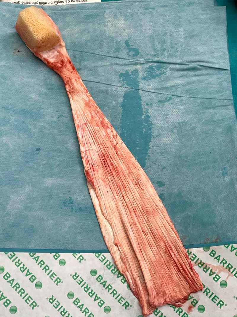 transferencias-tendinosas-lesiones-hombro-2 transferencias-tendinosas-lesiones-2