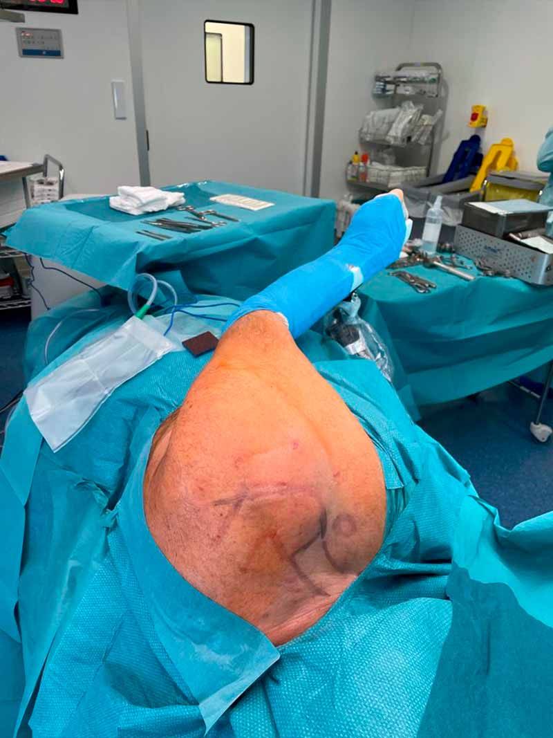 transferencias-tendinosas-lesiones-hombro transferencias-tendinosas-lesiones